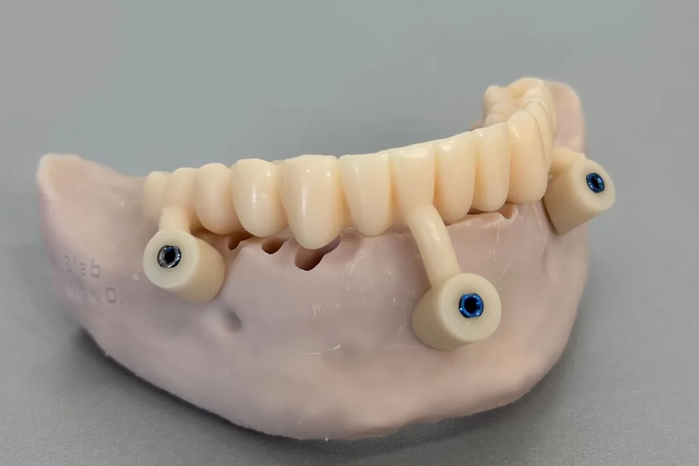 Caring for an All-on-4 or All-on-6 Prosthesis: Maintenance and Lifespan