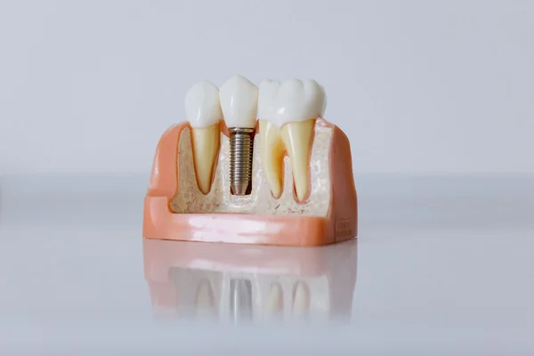All-on-4 mü, All-on-6 mı? Tam Çene İmplant Tedavisinde Hangisi Uygun?