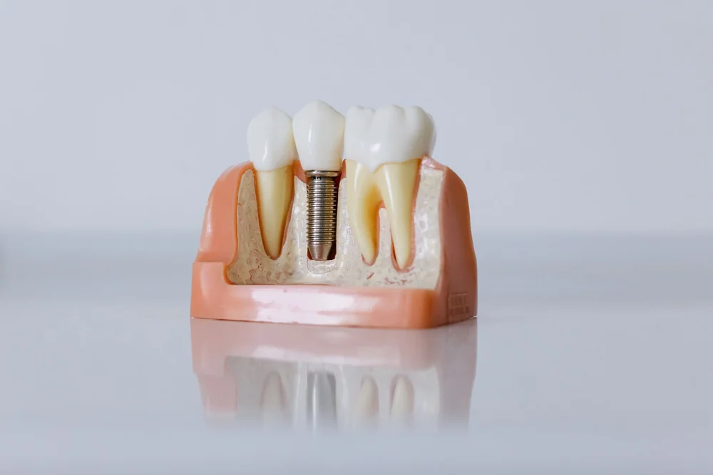 All-on-4 or All-on-6? Choosing a Full-Arch Implant Treatment