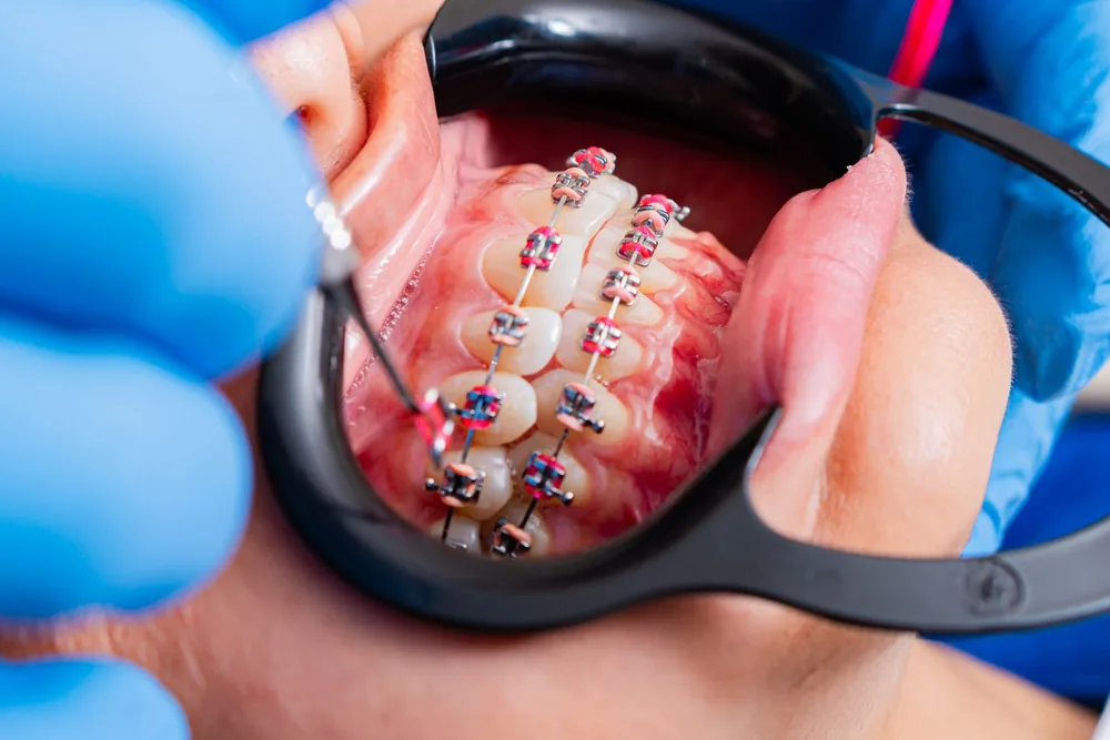 Eating and Oral Care with Braces: What You Need to Know