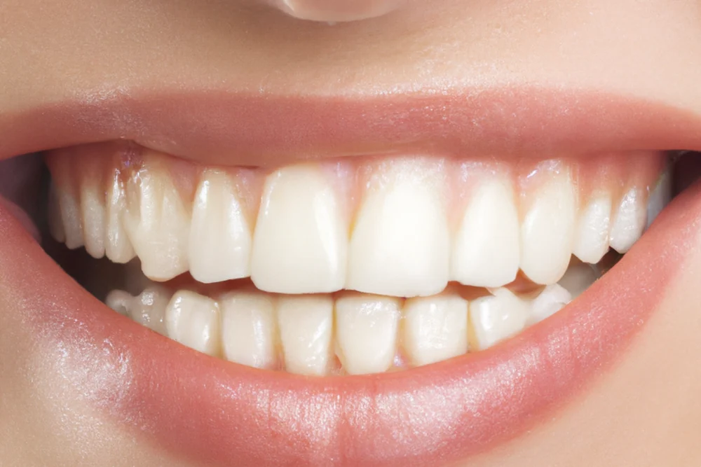 What Is a Gummy Smile? Causes and Treatment Approaches