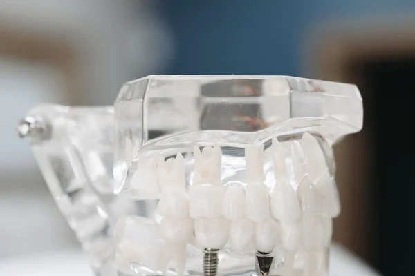 Implant or Bridge? How to Make the Right Choice for a Missing Tooth