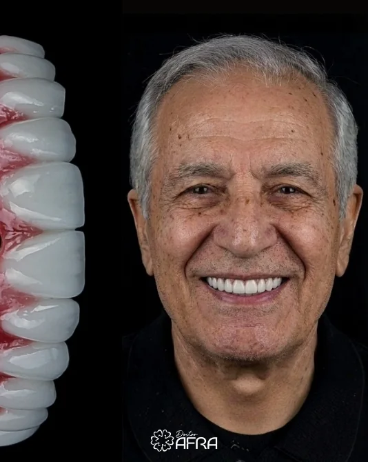 All-on-4 Implants