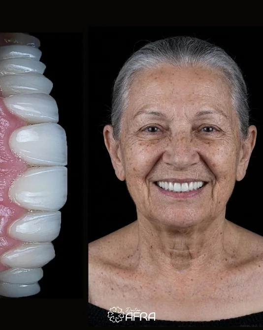All-on-6 Implants