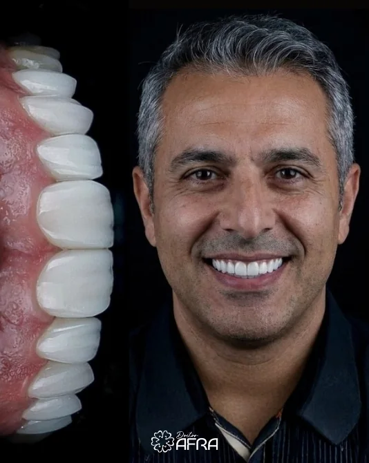 Porcelain Veneers