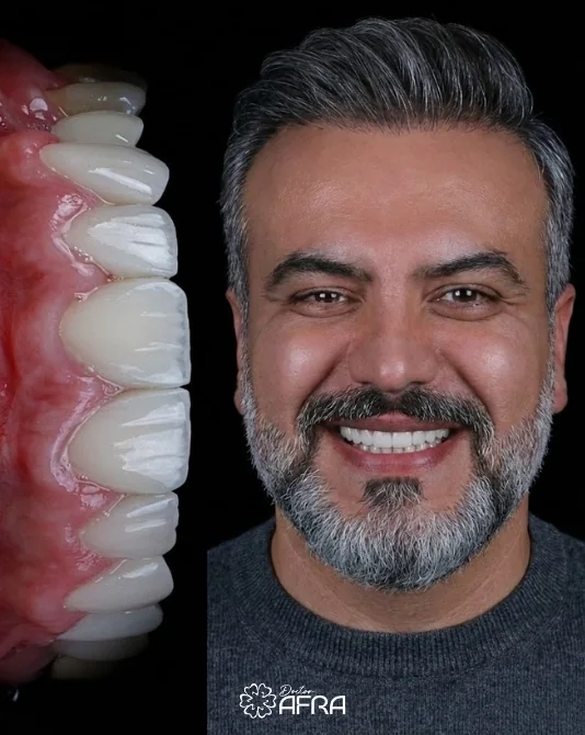 Zirconia Veneers