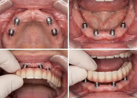 Implant Placement and Temporary Restoration