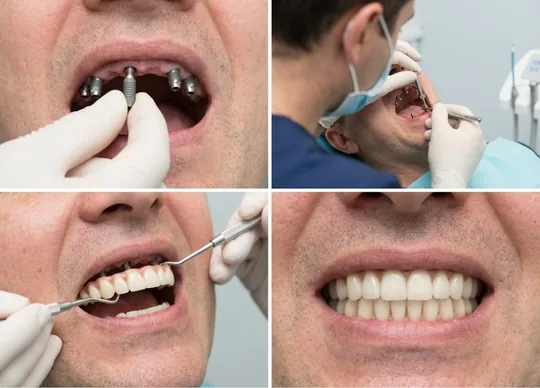 Surgical Procedure and Implant Placement