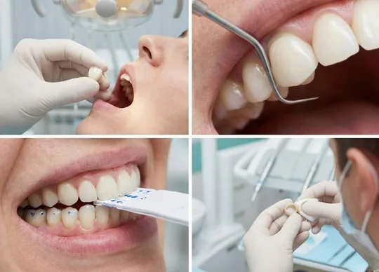 Zirconia Placement and Finishing
